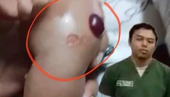 Perawat Lintang RSUD Dr Soewandi Akui Melakukan Tindakan Medis Tangan Bayi Bengkak dan Melepuh